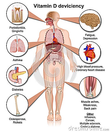 Vitamin D deviciency body effects medical illustration on white background Cartoon Illustration