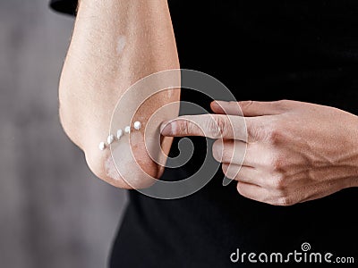 Vitiligo close-up well hands on a black background Stock Photo