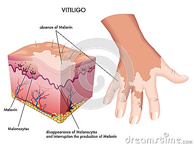 Vitiligo Vector Illustration