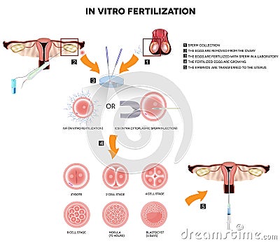 In vitro fertilization Vector Illustration