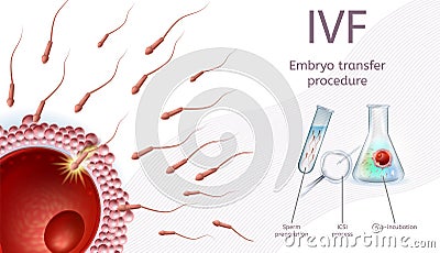In Vitro Fertilization Embryo Transfer Procedure. Vector Illustration