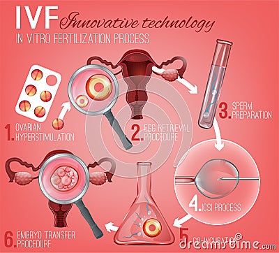 In Vitro Fertilization Vector Illustration