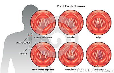 Vocal cord diseases Vector Illustration