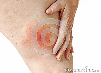 Wandering flush Lyme borreliosis of the leg of a woman transmitted by a tick Stock Photo