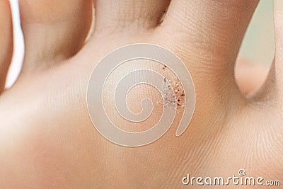 wart on a blunt close-up. Macro shot of human papilloma on the foot. Stock Photo