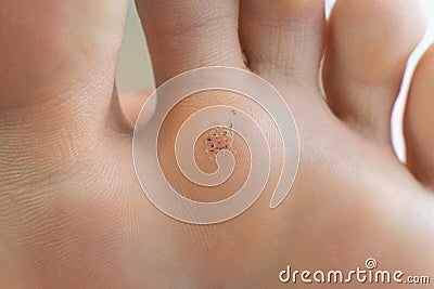 Wart on a blunt close up. Macro shot of human papilloma on the foot Stock Photo