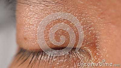 Wart on face. Macro shot of wart near eye. Papilloma on skin Stock Photo