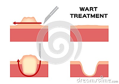 Wart treatment . remove it from skin by surgery callus Vector Illustration