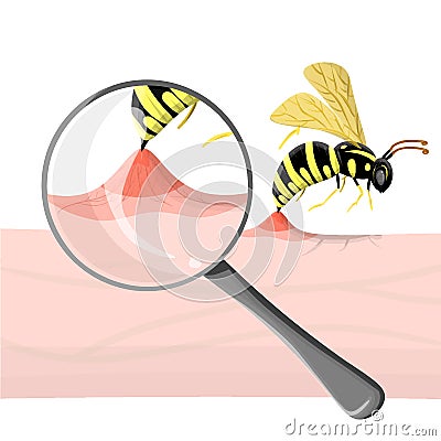 Wasp sting human. Close up detailed with magnifier pathogenesis of bee stings and allergic reaction. Vector illustration in Vector Illustration