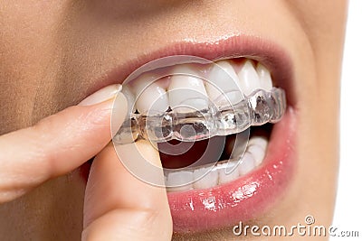 Wearing orthodontic silicone trainer Stock Photo