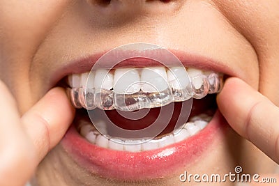 Wearing orthodontic silicone trainer Stock Photo