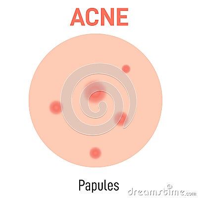 Papules skin acne type Vector Illustration