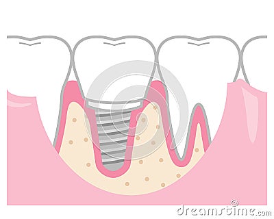 Implant treated teeth Vector Illustration