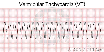 Electrocardiogram show monomorphic ventricular tachycardia VT. Vector Illustration