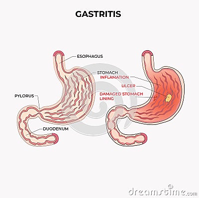Gastritis as stomach liling inflamation illness disease outline diagram Vector Illustration