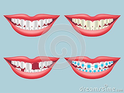 White, dirty, decayed, broken and orthodontics tooth Vector Illustration