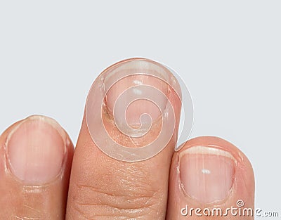 White spots on fingernails Stock Photo