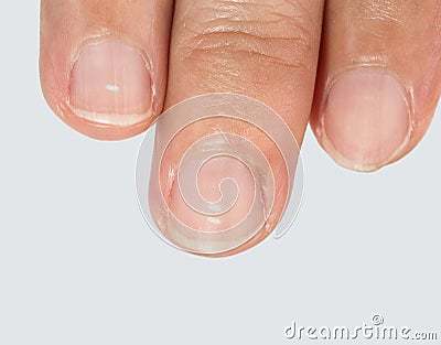 White spots on fingernails. Stock Photo