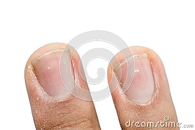 White spots on fingernails Stock Photo