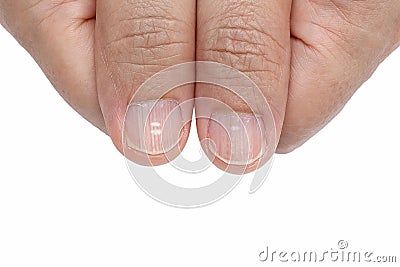 White spots and Vertical ridges on the fingernails Stock Photo