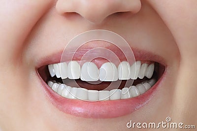 White teeth of a caucasian woman after treatment and whitening of teeth, dental crowns. Stock Photo