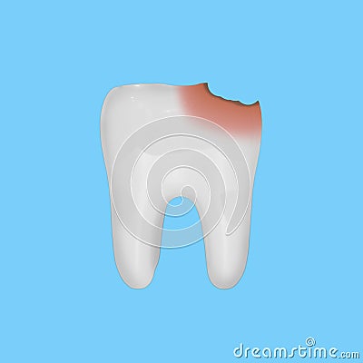 White tooth model with damage from caries, on blue background. Concept of care and dental health. Stock Photo