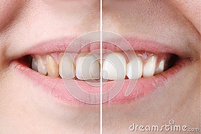 Whitening or bleaching treatment ,before and after ,woman teeth and smile, close up, on white Stock Photo