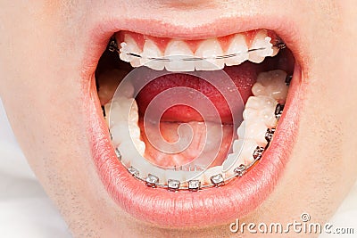 Wide opened mouth with self-ligating brackets Stock Photo