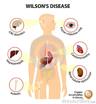 Wilson's disease Vector Illustration