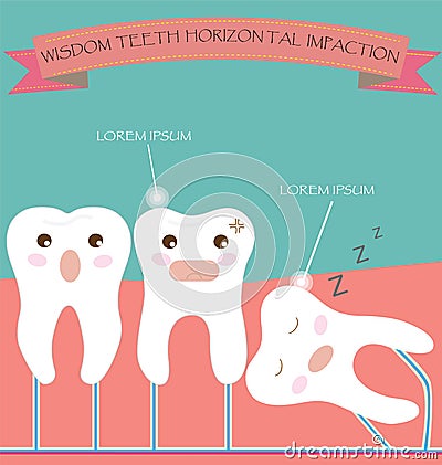 Wisdom Teeth Horizontal Impaction Vector Illustration