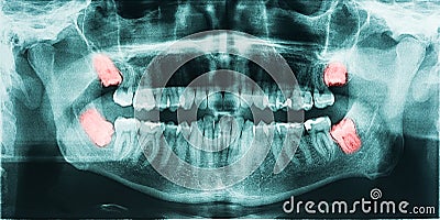 Wisdom Teeth Pain Stock Photo