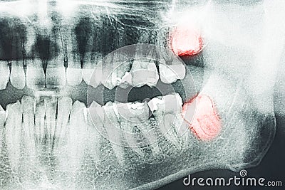 Wisdom Teeth Pain Stock Photo