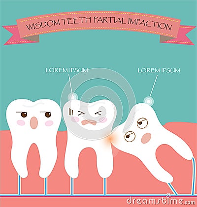 Wisdom Teeth Partial Eruption Impaction Vector Illustration