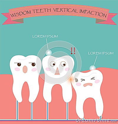 Wisdom Teeth Vertical Impaction Vector Illustration