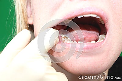 Wisdom teeth before surgery to remove. Stock Photo