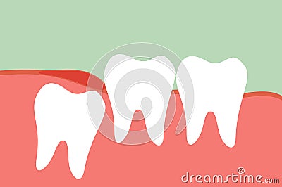 Wisdom tooth Vector Illustration