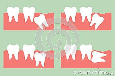Wisdom tooth Vector Illustration