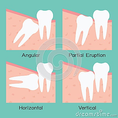 Wisdom Tooth Vector Illustration