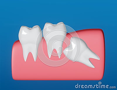 Wisdom tooth grows wrong, horizontal position of the wisdom tooth, Impacted wisdom tooth. 3d illustration. Cartoon Illustration