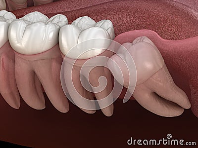 Wisdom tooth with impaction at molar tooth. Medically accurate tooth illustration Cartoon Illustration