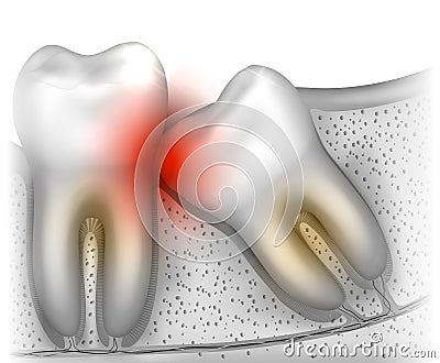 Wisdom tooth pain Vector Illustration