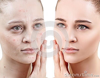 Woman with acne before and after treatment and make-up. Stock Photo