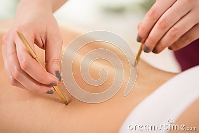 Woman during acupuncture session Stock Photo
