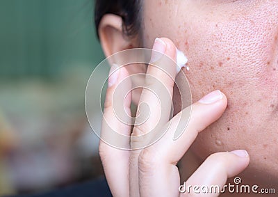 Woman applying cream onto face that has problem problematic skin , acne scars ,oily skin and pore, dark spots and blackhead and Stock Photo