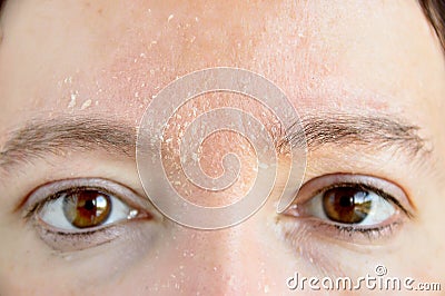 Woman with atopic dermatitis Stock Photo