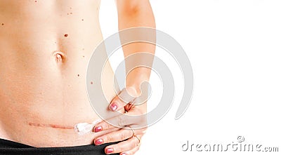 Woman belly with scar c Cesarean healing cream medicine isolated white background concept Stock Photo