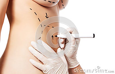 Woman body marked out for cosmetic surgery. Stock Photo