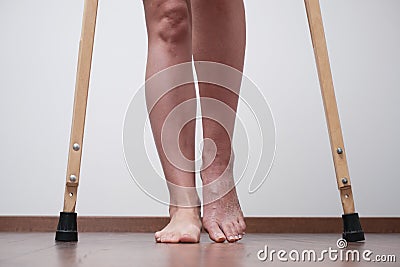 A woman after a broken leg to learn to walk. Rehabilitation after removal of plaster bandage. Stock Photo