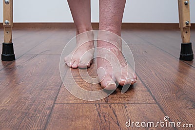 A woman after a broken leg to learn to walk. Rehabilitation after removal of plaster bandage. Stock Photo