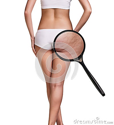 Woman with cellulitis on buttocks Stock Photo